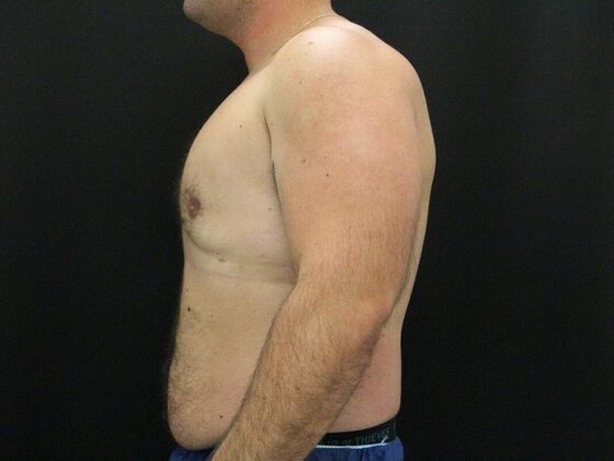 Gynecomastia & Male Breast Reduction: Case 3 - After