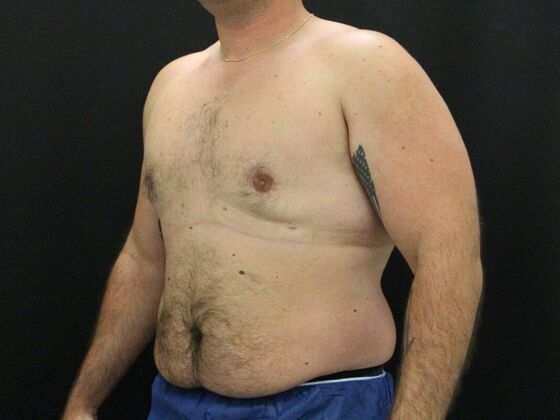 Gynecomastia & Male Breast Reduction: Case 3 - After