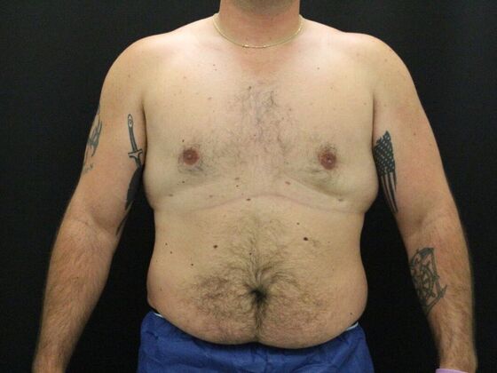 Gynecomastia & Male Breast Reduction: Case 3 - After