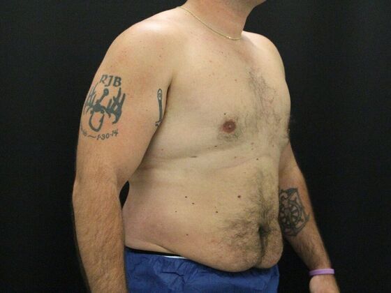 Gynecomastia & Male Breast Reduction Case 3 - After