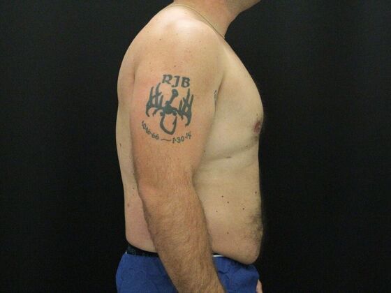 Gynecomastia & Male Breast Reduction: Case 3 - After