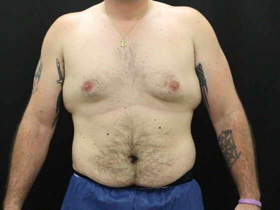 Gynecomastia & Male Breast Reduction: Case 3 - Before