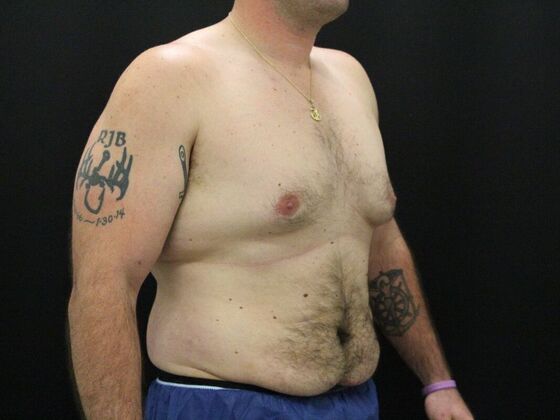 Gynecomastia & Male Breast Reduction Case 3 - Before