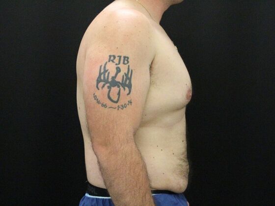 Gynecomastia & Male Breast Reduction: Case 3 - Before