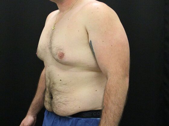 Gynecomastia & Male Breast Reduction: Case 3 - Before