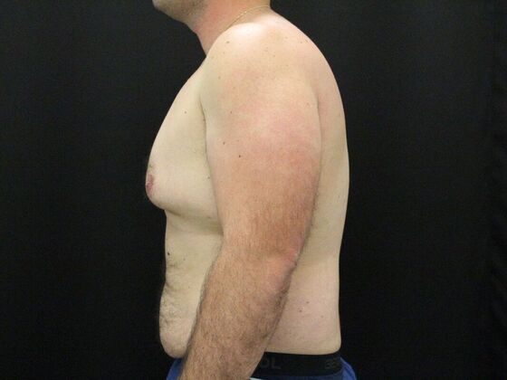 Gynecomastia & Male Breast Reduction: Case 3 - Before