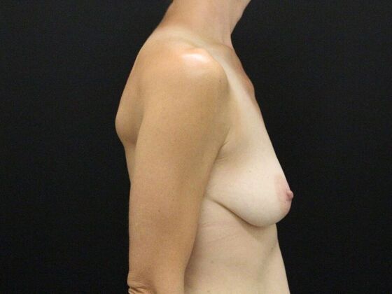 Breast Lift & Breast Lift Augmentation: Case 37 - Before