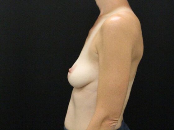 Breast Lift & Breast Lift Augmentation: Case 37 - Before