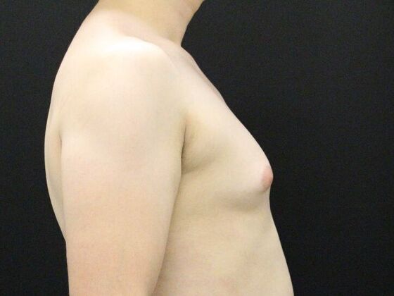 Liposuction: Case 45 - Before