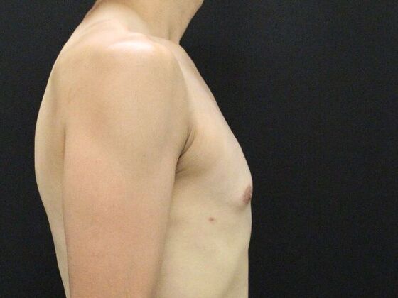 Liposuction: Case 45 - After