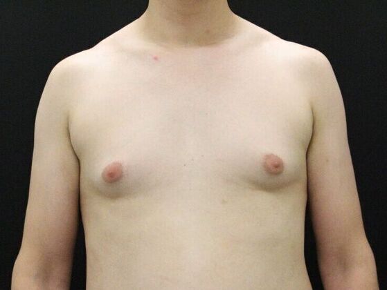 Liposuction Case 45 - Before