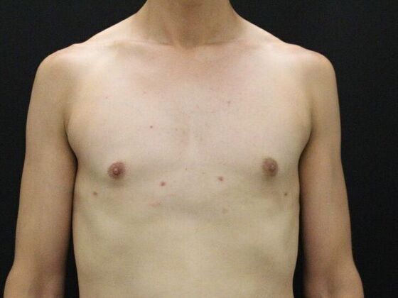Liposuction Case 45 - After