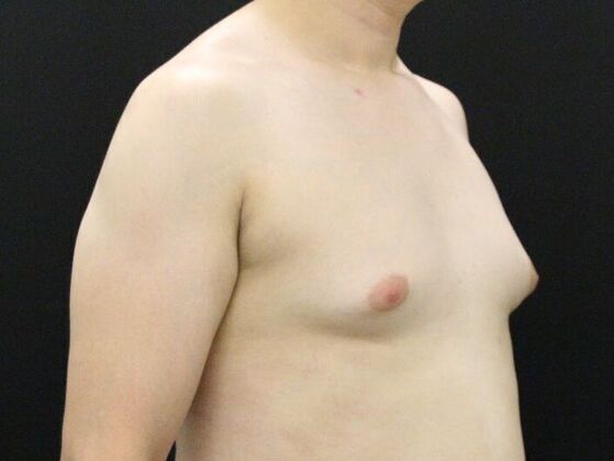 Liposuction: Case 45 - Before