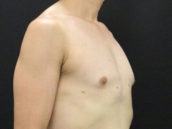 Liposuction: Case 45 - After