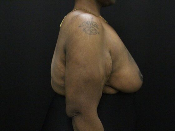 Breast Reduction & Lift: Case 26 - After