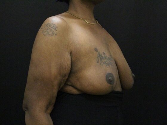 Breast Reduction & Lift: Case 26 - After