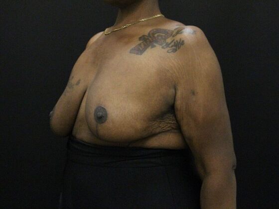 Breast Reduction & Lift: Case 26 - After