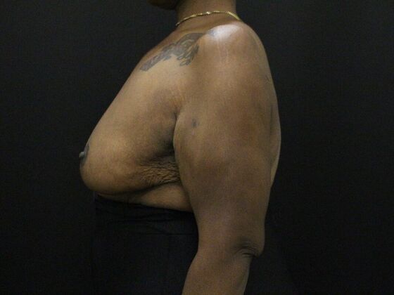 Breast Reduction & Lift: Case 26 - After