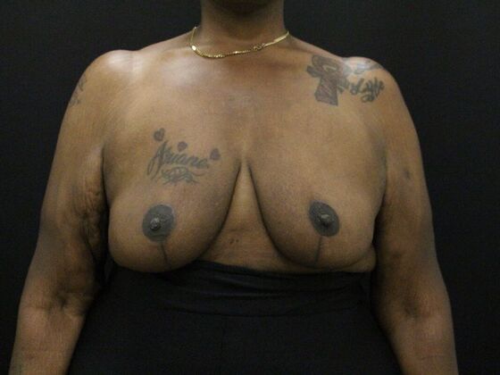 Breast Reduction & Lift Case 26 - After