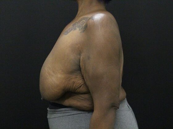 Breast Reduction & Lift: Case 26 - Before