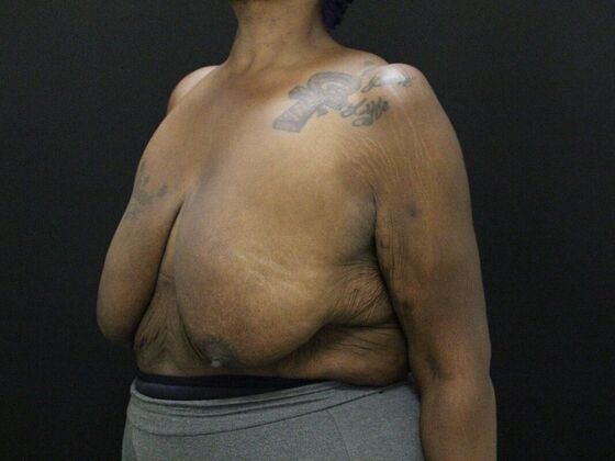 Breast Reduction & Lift: Case 26 - Before