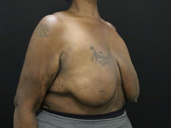 Breast Reduction & Lift: Case 26 - Before