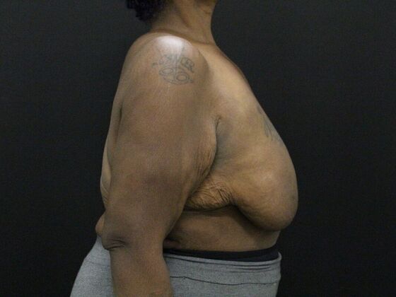 Breast Reduction & Lift: Case 26 - Before