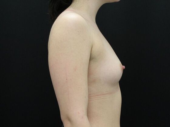 Breast Augmentation: Case 38 - Before