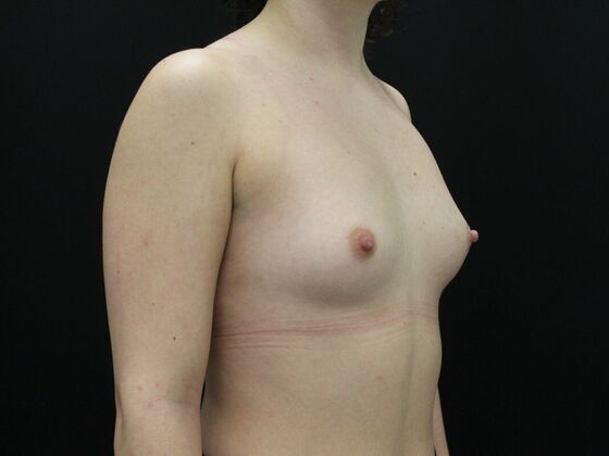 Breast Augmentation: Case 38 - Before