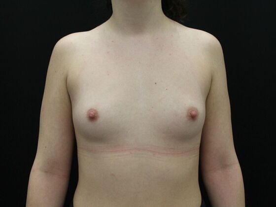 Breast Augmentation Case 38 - Before