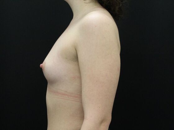 Breast Augmentation: Case 38 - Before