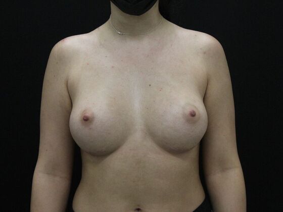 Breast Augmentation Case 38 - After