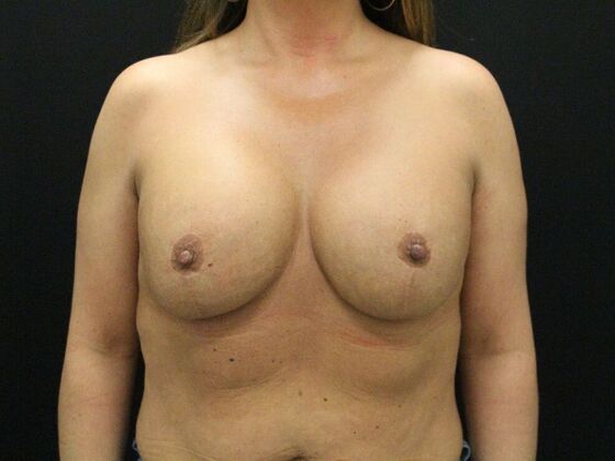 Breast Lift & Breast Lift Augmentation Case 38 - After