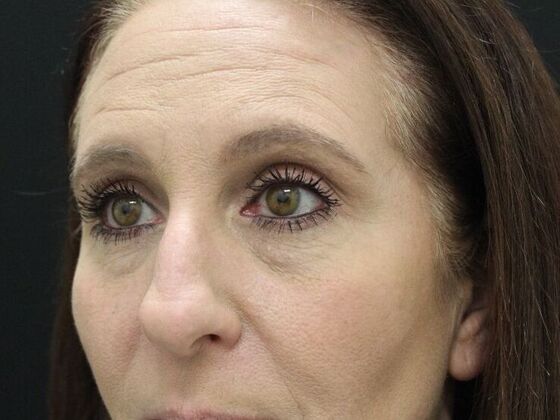 Eyelid Surgery: Case 2 - Before