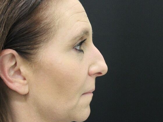 Eyelid Surgery: Case 2 - Before