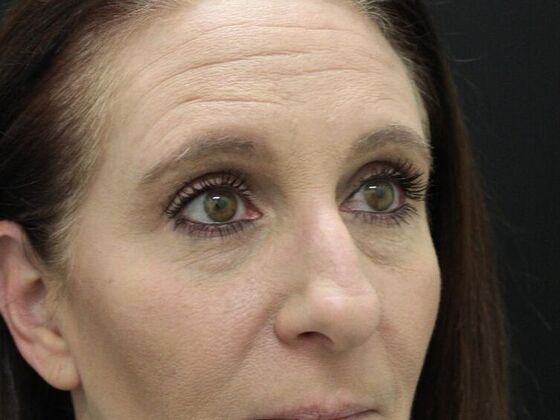 Eyelid Surgery: Case 2 - Before