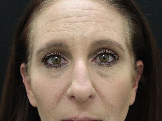 Eyelid Surgery Case 2 - Before