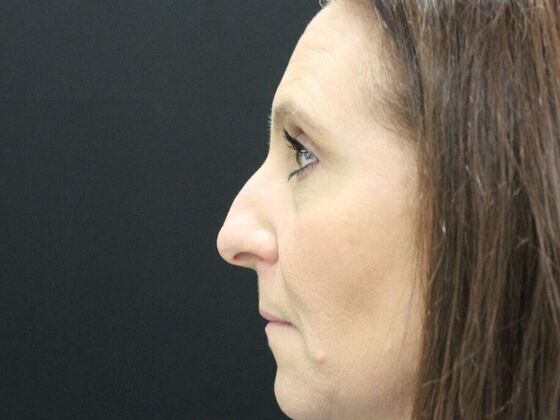 Eyelid Surgery: Case 2 - Before