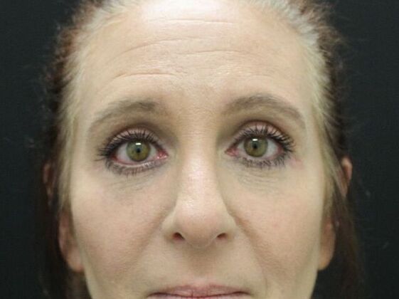 Eyelid Surgery Case 2 - After