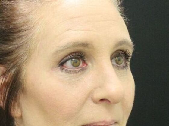 Eyelid Surgery: Case 2 - After