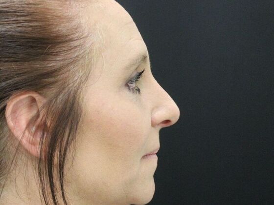 Eyelid Surgery: Case 2 - After