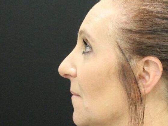 Eyelid Surgery: Case 2 - After