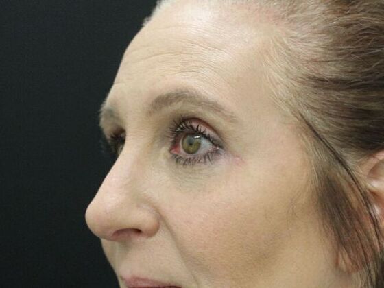 Eyelid Surgery: Case 2 - After