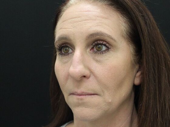 Rhinoplasty: Case 3 - Before