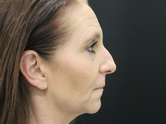 Rhinoplasty Case 3 - Before