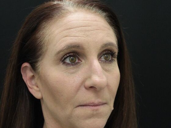 Rhinoplasty: Case 3 - Before