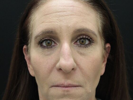 Rhinoplasty: Case 3 - Before