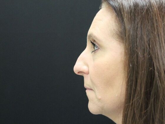 Rhinoplasty: Case 3 - Before