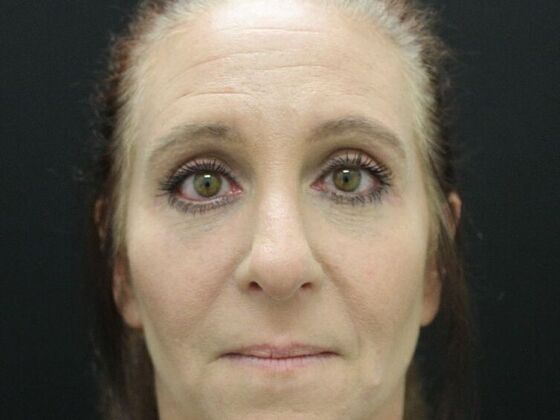 Rhinoplasty: Case 3 - After