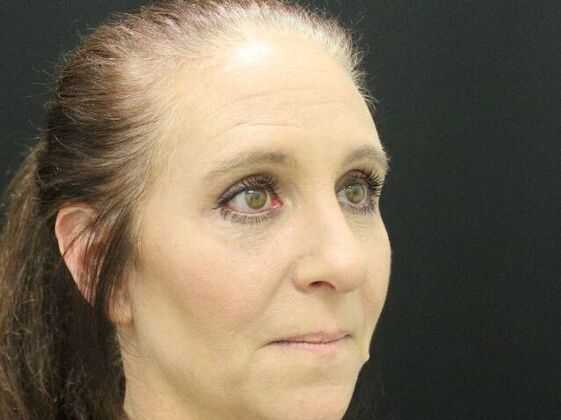 Rhinoplasty: Case 3 - After